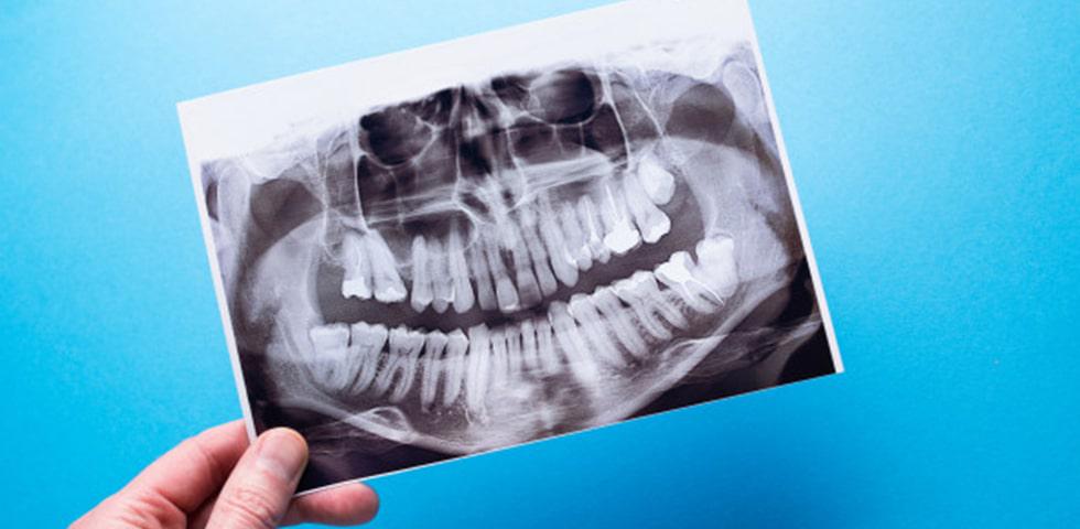 Üçüncü Gözümüz Tomografi Nedir?