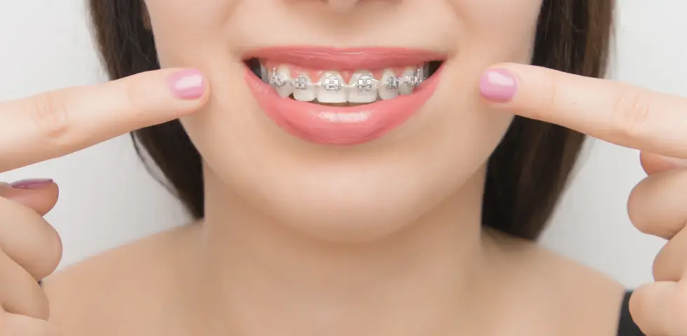 Diş Teli Takıldıktan Sonra Dişler Ne Zaman Düzelmeye Başlar