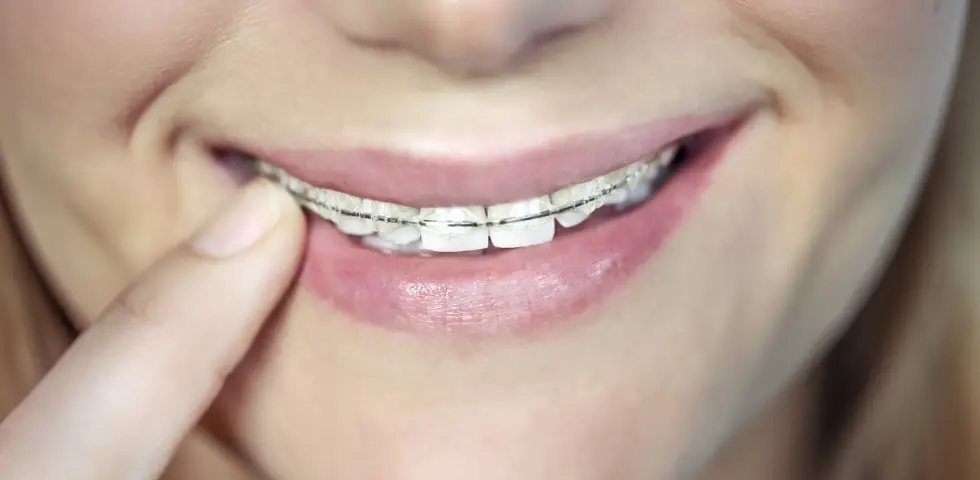 Porselen Diş Teli Nedir ve Hangi Tedavilerde Kullanılır?